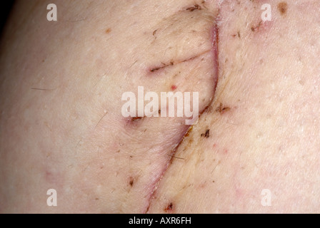 Cicatrice sur l'intérieur de la cuisse gauche de l'opération pour enlever un sarcome des tissus mous de haute qualité sur les points de suture retirés Banque D'Images