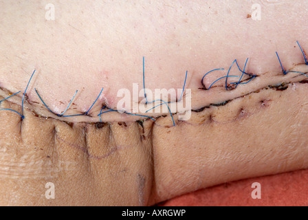 Close up de suture sur la cuisse intérieure gauche de l'opération pour supprimer un grade élevé sur les sarcomes des tissus mous Banque D'Images