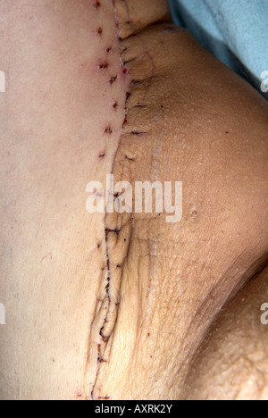 Cicatrice sur l'intérieur de la cuisse gauche de l'opération pour supprimer un grade élevé sur les sarcomes des tissus mous Banque D'Images