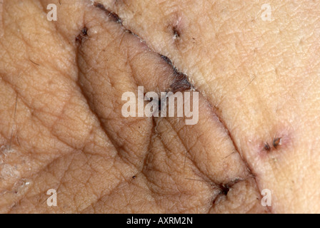 Cicatrice sur l'intérieur de la cuisse gauche de l'opération pour enlever un sarcome des tissus mous de haute qualité sur les points de suture retirés Banque D'Images