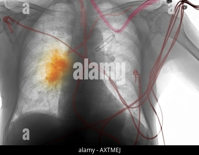 La radiographie du thorax d'un homme âgé de 80 ans avec de longs antécédents de tabagisme, qui a développé le cancer Banque D'Images