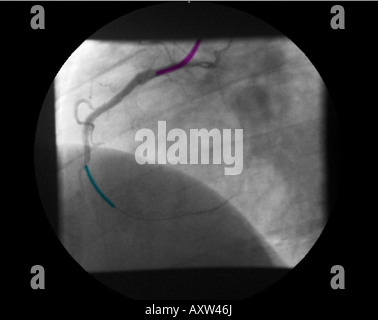 Colorisée numériquement améliorée, radiographie d'une coronarographie montrant un stent à ouvrir la sténose de l'artère coronaire droite Banque D'Images