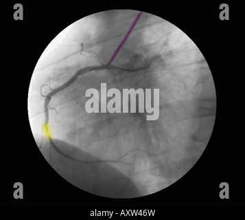 Colorisée numériquement améliorée, radiographie d'une coronarographie montrant une sténose de l'artère coronaire droite Banque D'Images