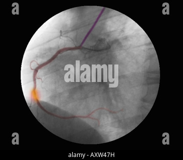 Colorisée numériquement améliorée, radiographie d'une coronarographie montrant une sténose de l'artère coronaire droite Banque D'Images