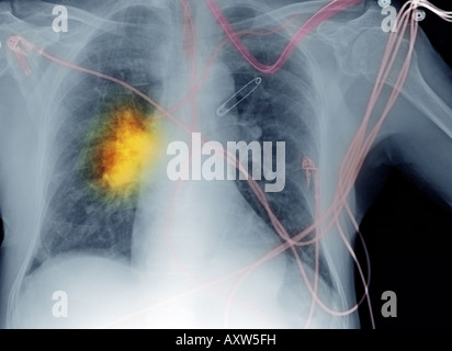 La radiographie du thorax d'un homme âgé de 80 ans avec de longs antécédents de tabagisme, qui a développé le cancer Banque D'Images