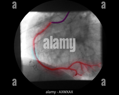 Colorisée numériquement améliorée, radiographie d'une coronarographie montrant un stent à ouvrir la sténose de l'artère coronaire droite Banque D'Images