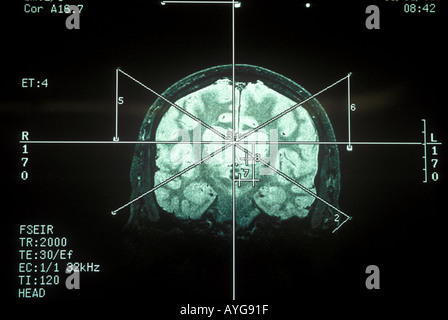 Humaine IRM du cerveau Banque D'Images