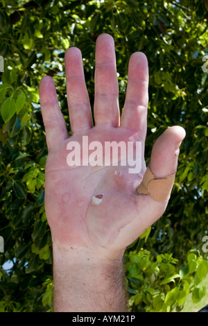 Main humaine avec des cloques et un bandage Banque D'Images