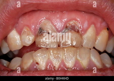 Les caries dentaires, gros plan sur une bouche avec de mauvaises dents Banque D'Images