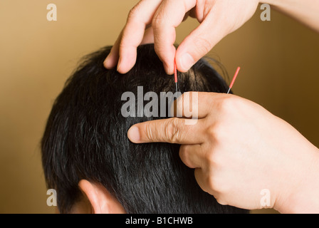 Médecin de mettre les aiguilles d'acupuncture sur la tête du patient Banque D'Images