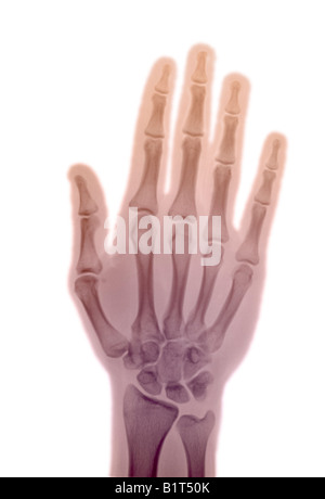 X-ray de 21 year old man's hand Banque D'Images