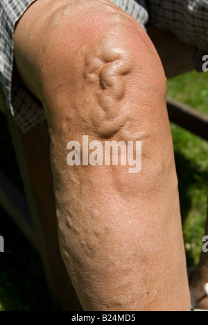 Stock photo d'une femme de soixante dix ans jambes l'image montre l'varices sur les jambes Banque D'Images