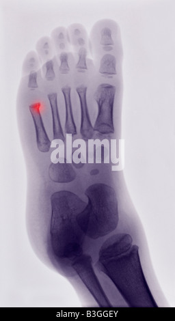 X ray du pied d'un garçon présentant une fracture de la 5ème boucle métatarse Banque D'Images