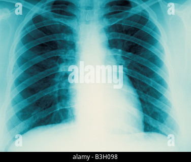 Close-up de radiographie de diagnostic de l'image montrant les poumons et la cage thoracique Banque D'Images