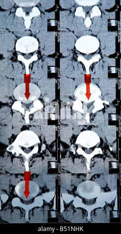 Une radiographie d'une hernie discale Banque D'Images