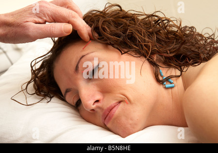 Les aiguilles d'acupuncture est appliquée sur le visage d'une femme adulte, fin des années 20 Banque D'Images