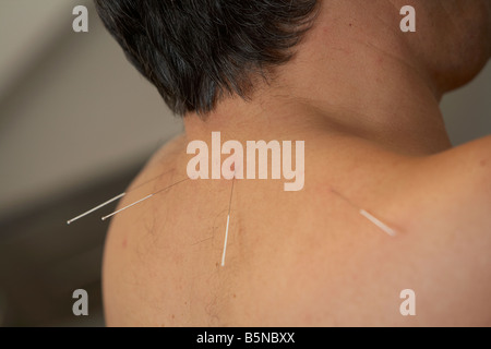 Les aiguilles d'acupuncture sur l'oreille et le cou d'un homme adulte années 50 Banque D'Images