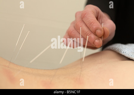 Application d'aiguilles d'acupuncture acupuncteur femelle pour le bas du dos d'une femme adulte, fin des années 20 pour soulager les maux de dos Banque D'Images