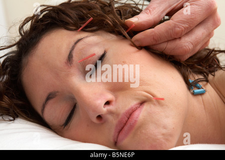 Les aiguilles d'acupuncture est appliquée sur le visage d'une femme adulte, fin des années 20 Banque D'Images