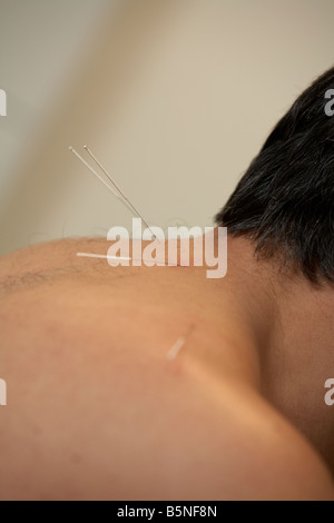Les aiguilles d'acupuncture sur l'oreille et le cou d'un homme adulte années 50 Banque D'Images