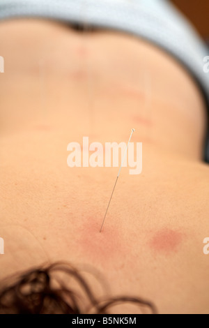 Aiguille d'acupuncture appliquée au haut du dos d'une femme adulte, fin des années 20 pour soulager les maux de dos Banque D'Images