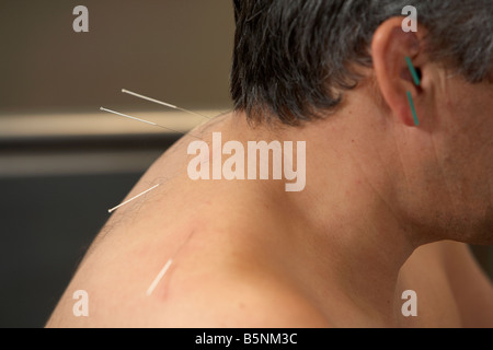 Les aiguilles d'acupuncture sur l'oreille et le cou d'un homme adulte années 50 Banque D'Images
