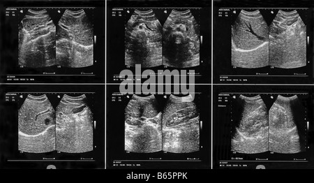 Échographie abdominale d'une femme. Numérisation haute résolution. Banque D'Images