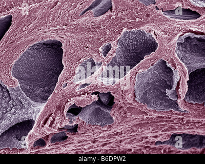 Le cancer de la prostate, la couleur de l'analyse des électrons Microphotographie (SEM). Banque D'Images