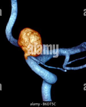 Anévrisme carotidien. Angiographie numérique couleur 3D d'un anévrisme (orange ball) dans l'artère carotide interne gauche. Banque D'Images