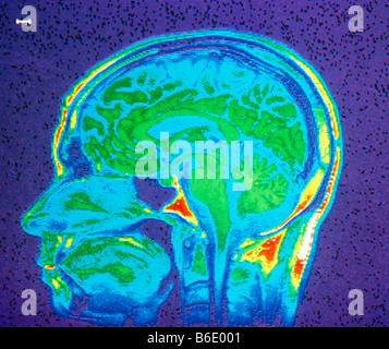 La résonance magnétique nucléaire (RMN) l'image d'une coupe sagittale au moyen d'une tête humaine. Banque D'Images