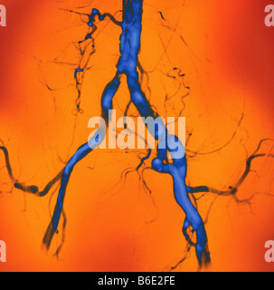 Artères abdominales rétrécie, angiographie couleur(vaisseau sanguin X-ray). L'aorte, l'bodyandamp mainartery;apos;s, est en haut. Banque D'Images