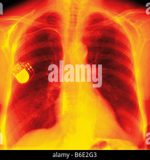 Stimulateur cardiaque. X-ray frontal de couleur d'une poitrine avec un stimulateur cardiaque (jaune, en haut à gauche). Banque D'Images