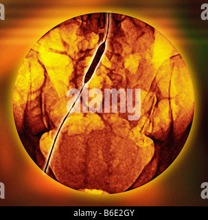 L'angioplastie de l'artère iliaque. Angiogramme couleur d'aniliac avec un cathéter à ballonnet. Banque D'Images