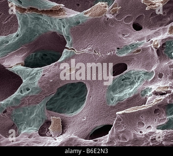 L'os ostéoporotique, couleur de l'analyse des electronmicrograph (SEM). Banque D'Images