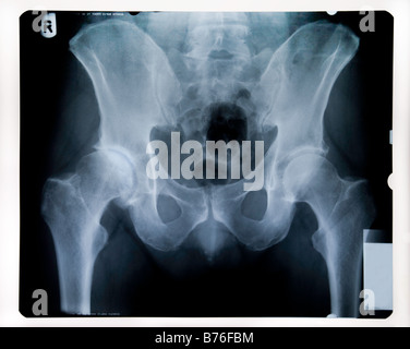 X-RAY DE BASSIN PAR DES HOMMES PORTÉS SUR LA HANCHE Banque D'Images