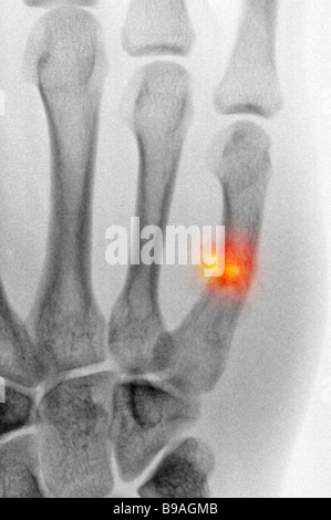 X-ray colorisée montrant une fracture de boxeurs de guérison, une pause au 5ème métacarpe de la main Banque D'Images