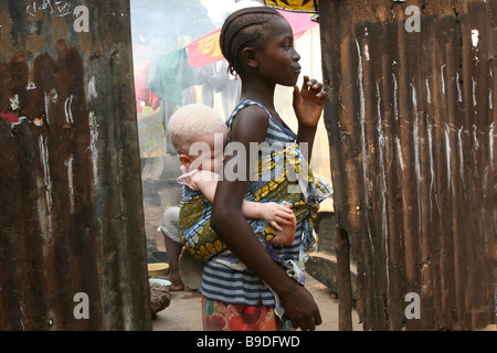 Jeune fille albinos de couchage en Sierra Leone, l'Afrique, à l'arrière de sa soeur Banque D'Images