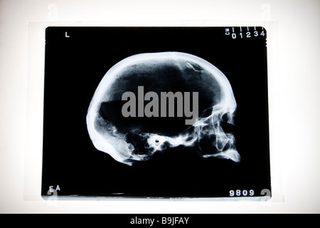 X-ray de crâne humain avec fracture émoussé Banque D'Images