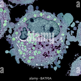 Couleur carcinome, electronmicrograph de transmission (TEM). Un carcinome est un cancer malin des cellules épithéliales. Banque D'Images