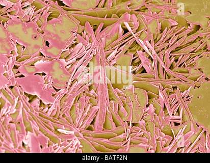 Calculs biliaires. Couleur de l'analyse des électrons Microphotographie (SEM) d'une fracture de la lithiase biliaire. Les calculs biliaires se forment dans la vésicule Banque D'Images