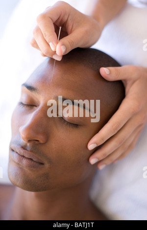 L'acupuncture. Acupuncteur l'insertion d'une aiguille dans le front d'un client. Banque D'Images