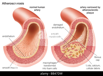 L'ATHÉROSCLÉROSE : Comparaison d'une artère normale avec une artère rétrécie par la plaque d'athérome Banque D'Images