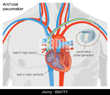 Schéma d'un stimulateur cardiaque Banque D'Images