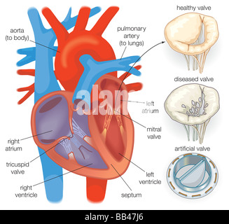 Schéma présentant un cœur en bonne santé par rapport à une vanne valve cardiaque malade et d'une valve cardiaque artificielle. Banque D'Images