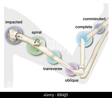 Types de fractures des os. Banque D'Images