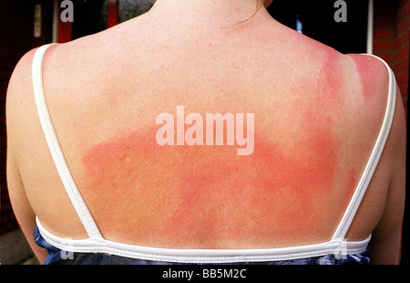 Jeune femme avec un coup de soleil à l'arrière et les épaules Banque D'Images