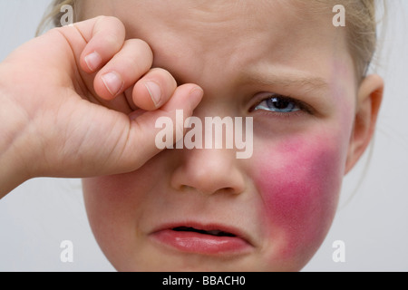 Une petite fille avec un bleu sur sa joue de pleurer Banque D'Images