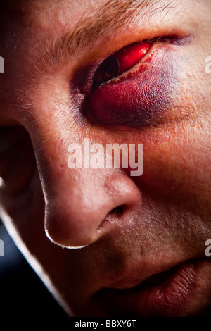 Close up of man avec de véritables yeux injectés de l'accent sur l'œil noir Banque D'Images