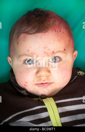 Couverts bébé dans la varicelle de poulet des taches sur la face. Banque D'Images