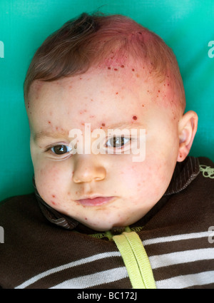 Couverts bébé dans la varicelle de poulet des taches sur la face. Banque D'Images